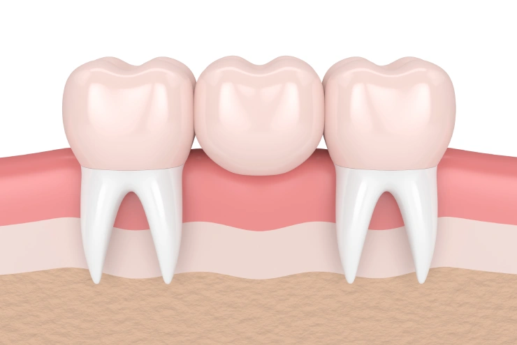 Custom Crowns and Bridges